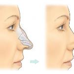 What is rhinoplasty