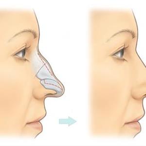 What is rhinoplasty